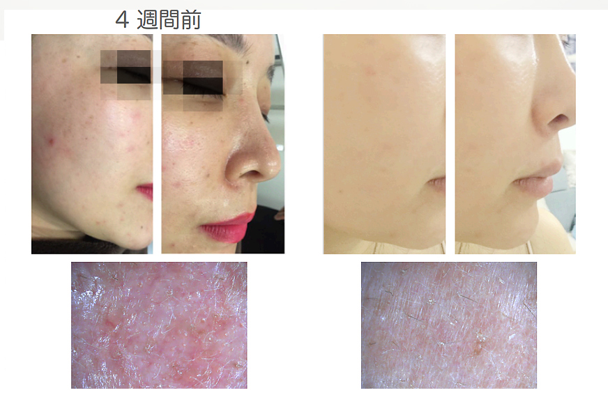 35歳女性 自営業 乾燥肌 ハダキララの使用から4週間で肌の赤み 炎症 ニキビが消えて キメが改善しました 劇的な美白効果も見られました ハダキララのbefore Afterを写真付きで一挙大公開